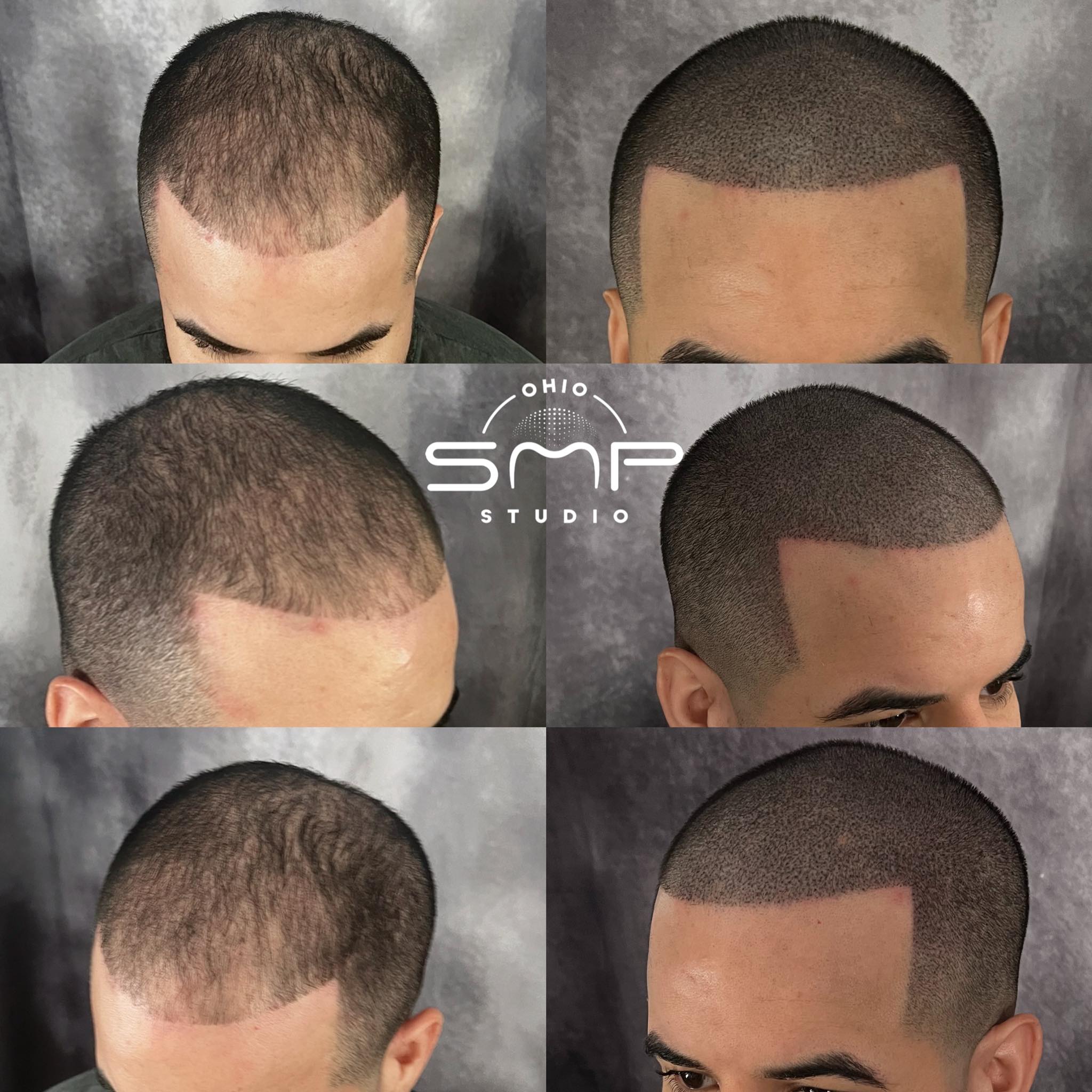The Permanent Hair Loss Solution: Scalp Micropigmentation
